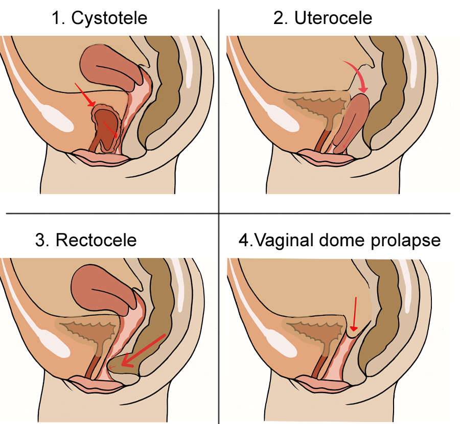 Vaginal Prolapse Porn - tpes of vaginal prolapse - Posterior vaginal prolapse ...